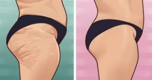 Cellulite